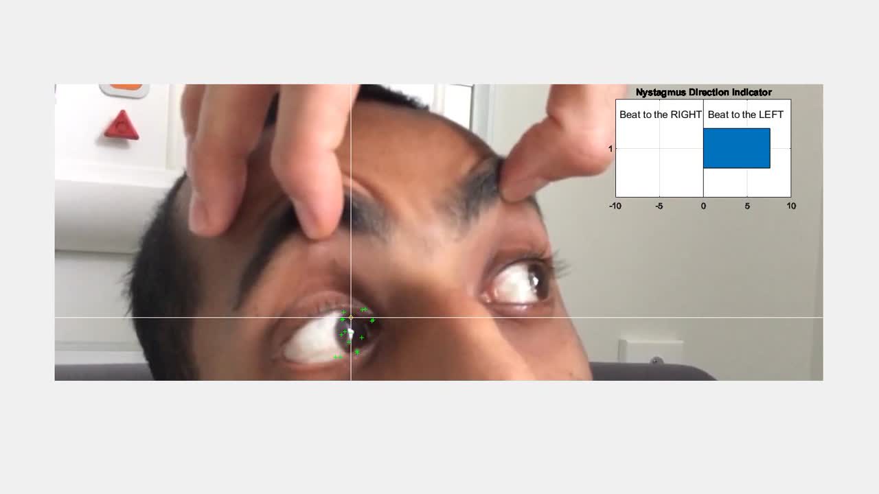- The Stroke-related Acute Vertigo Eye Detector (SAVED) App